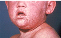 measles