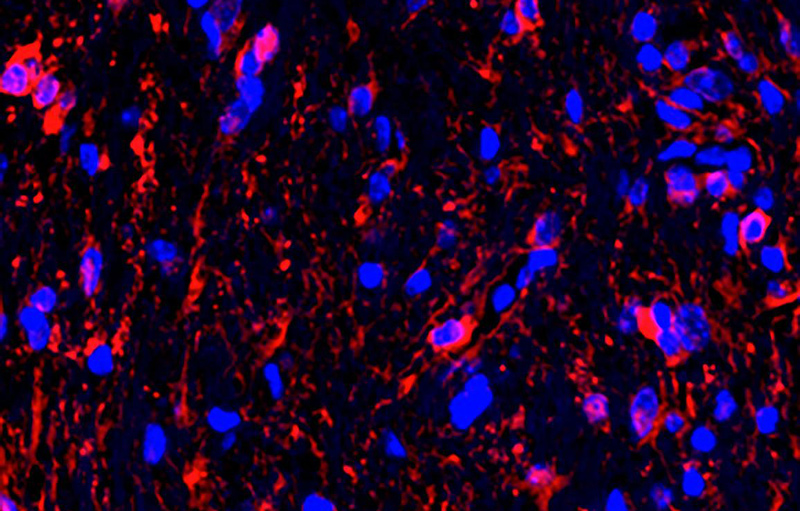 20210601 glioma