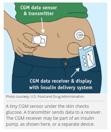 glucose monitoring