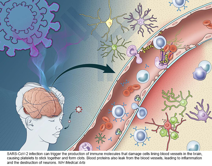 20220705 covid brain