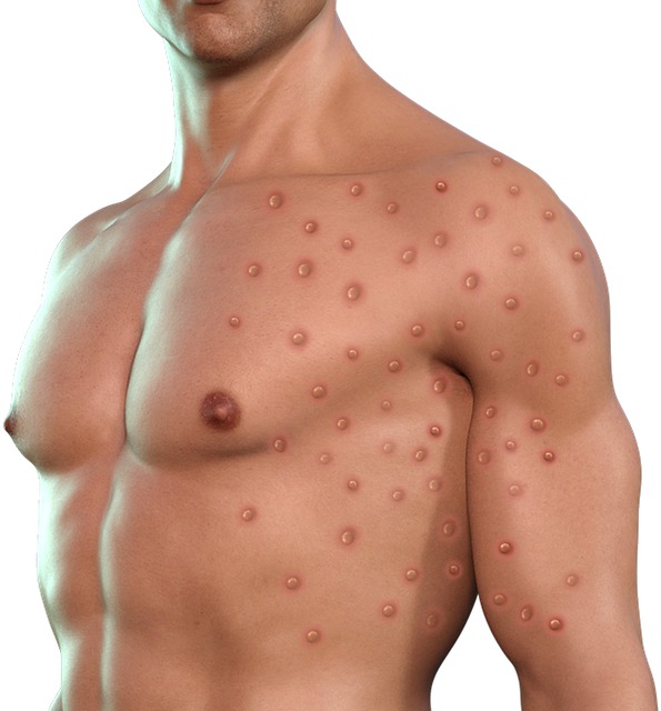 monkeypox 7219694 640