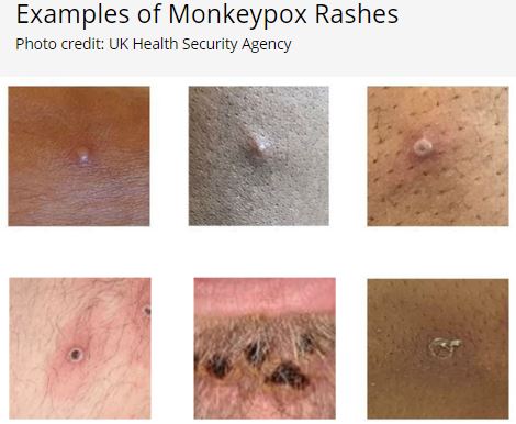 monkeypox.uk