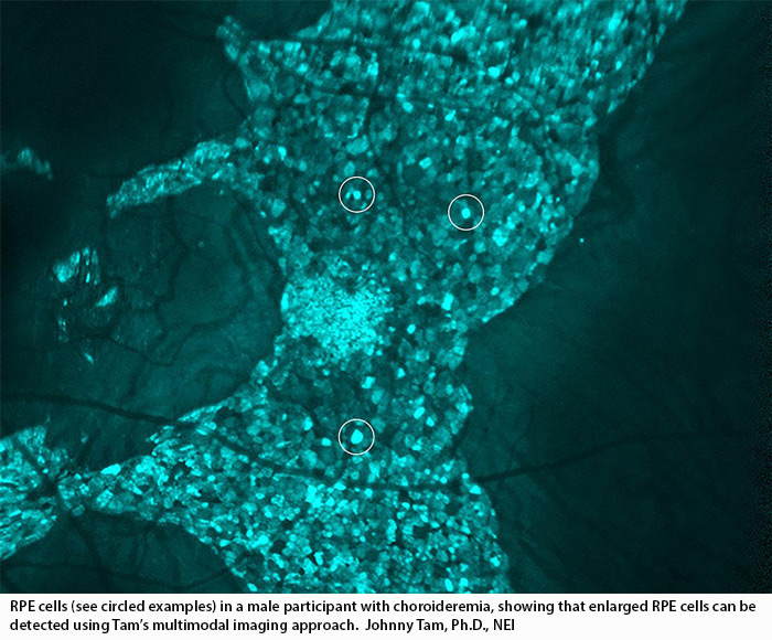 NIH 20220913 diseased eye