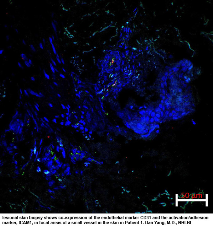 NIH 20230328 autoinflammatory