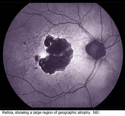 NIH 20240320 eye