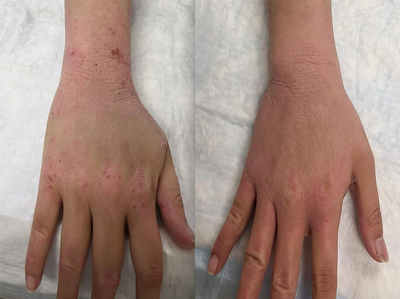 NIH tsw treatment