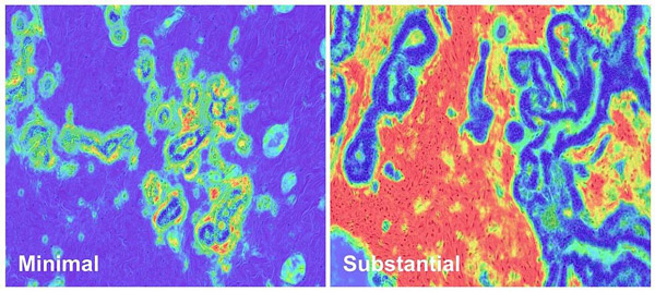 NIH 20250514 stromal disruption minimal substantial