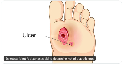 NIH ulcer