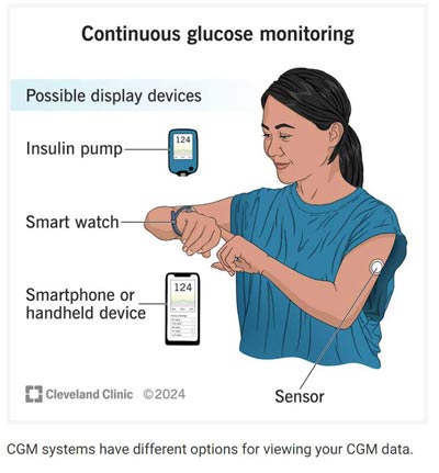 Continuous glucose monitoring graphic