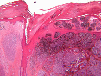 NIH 20260421 melanoma