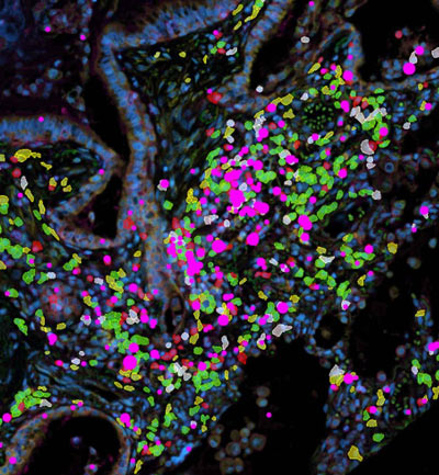 ucsf417 fibroblast and immune cell clusters