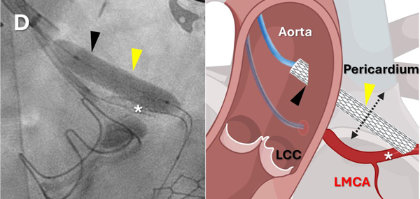 NIH coronary bypass nhlbi 600