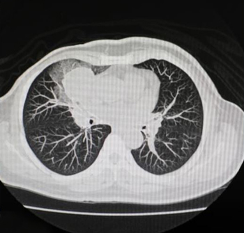 NIH CT scan