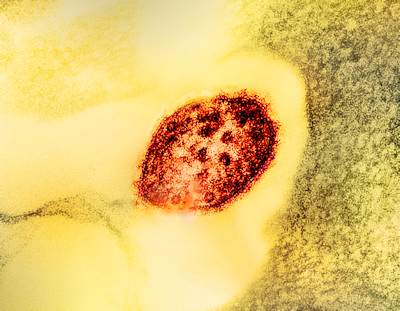 NIH 202520514 measles