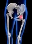 Beyond Arthritis: Yale School of Medicine Lists Three Causes of Hip Pain that Can Lead to Joint Replacement