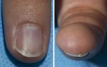 NIH Reports Benign Nail Condition Linked to Rare Syndrome that Greatly Increases Cancer Risk