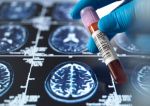 NIH Reports New Alzheimer’s Blood Test May Tell When Symptoms are Around the Corner