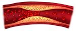 Yale School of Medicine Study Finds Cancer Drug Reduces Atherosclerosis Inflammation and Plaque