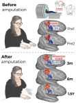 NIH Reports Phantom Limb Study Rewires Our Understanding of the Brain