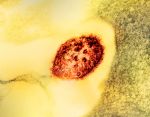 NIH Researchers Identify First Suite of Human Antibodies Against Measles Virus
