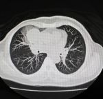 NIH-Funded Research Suggests Automated CT Scan Analysis Could Fast-Track Clinical Assessments